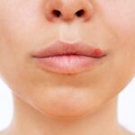 Close-up of a person’s lower face showing a visible red bump on the lip, trying to distinguishing between a cold sore and a lip pimple